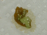 緑色尿酸